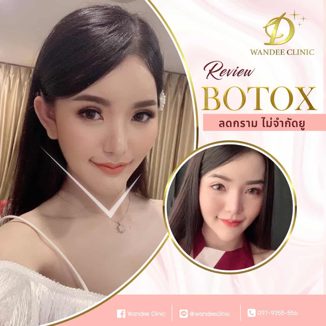รีวิว botox