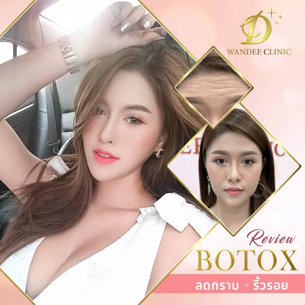 รีวิว โบท็อกซ์