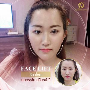 รีวิว ร้อยไหม