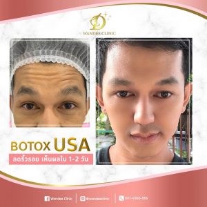 รีวิว โบท็อกซ์