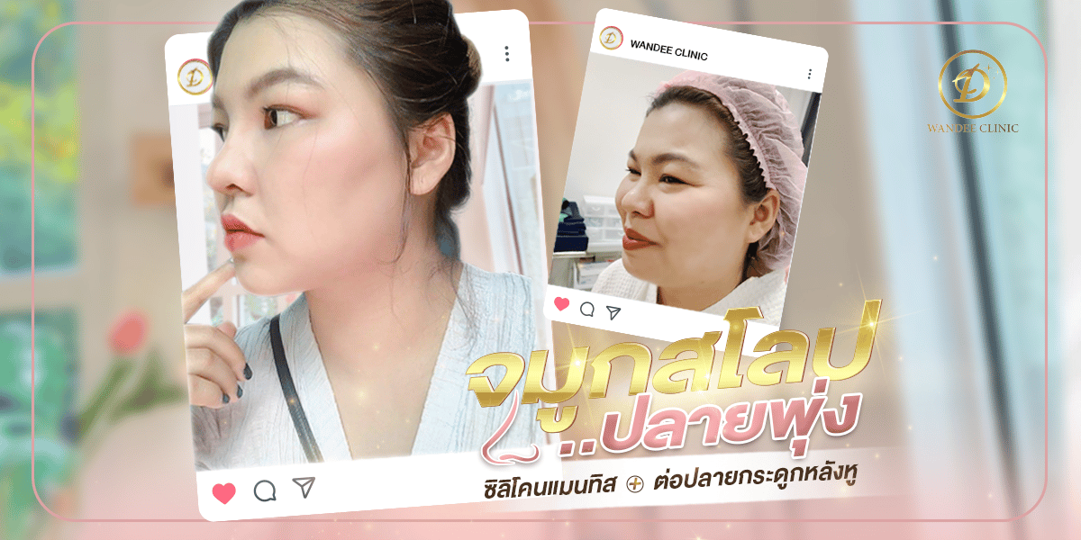 รีวิวเสริมจมูก