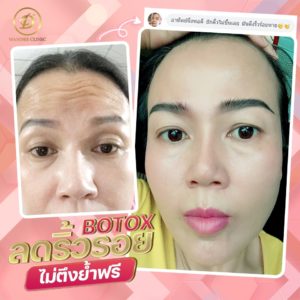 Botox ลดริ้วรอย