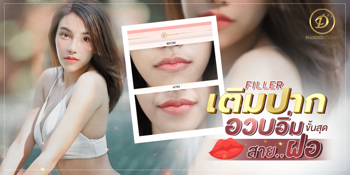 รีวิวฉีดฟิลเลอร์