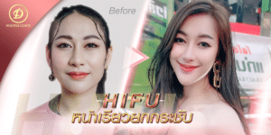 รีวิว HIFU