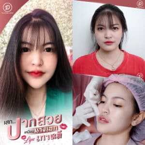 ฟิลเลอร์