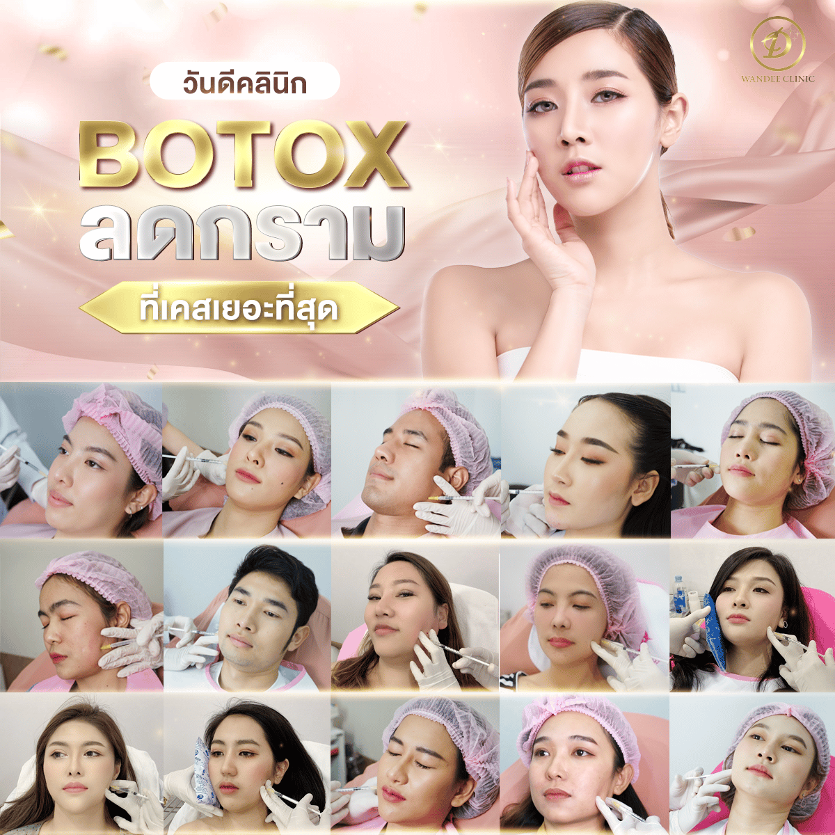 Allergan Botox คือ