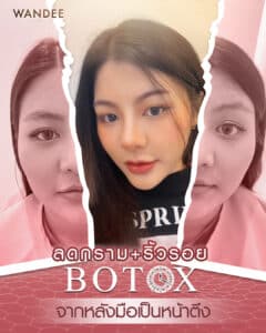 𝐁𝐨𝐭𝐨𝐱 ลดริ้วรอย+ลดกราม