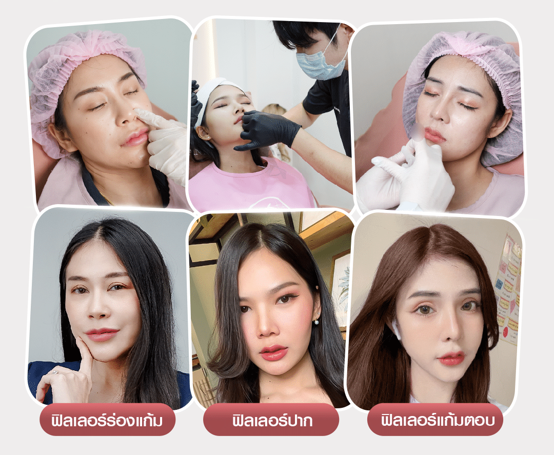 ฉีดฟิลเลอร์