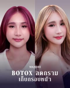 𝐁𝐨𝐭𝐨𝐱 ลดกราม