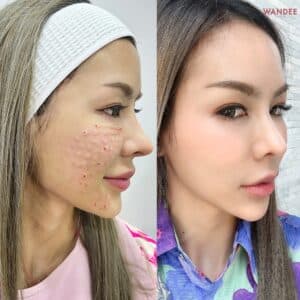 ฉีด Belotero Revive