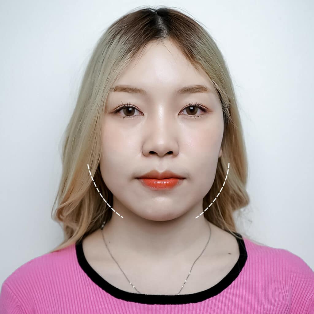 โบท็อกซ์