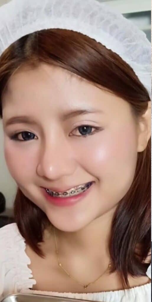 โบท็อกซ์