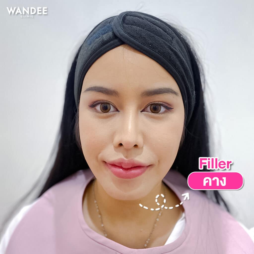 𝐅𝐢𝐥𝐥𝐞𝐫 ใบหน้า