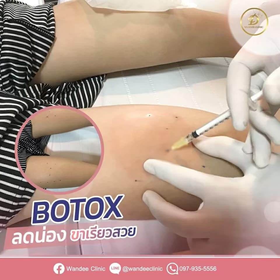 ฉีด botox ที่ไหนดี