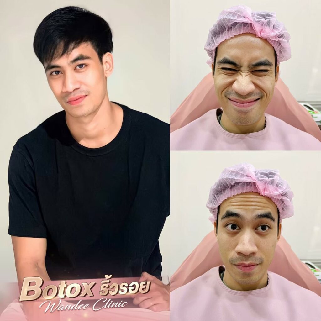 ฉีด botox ที่ไหนดี