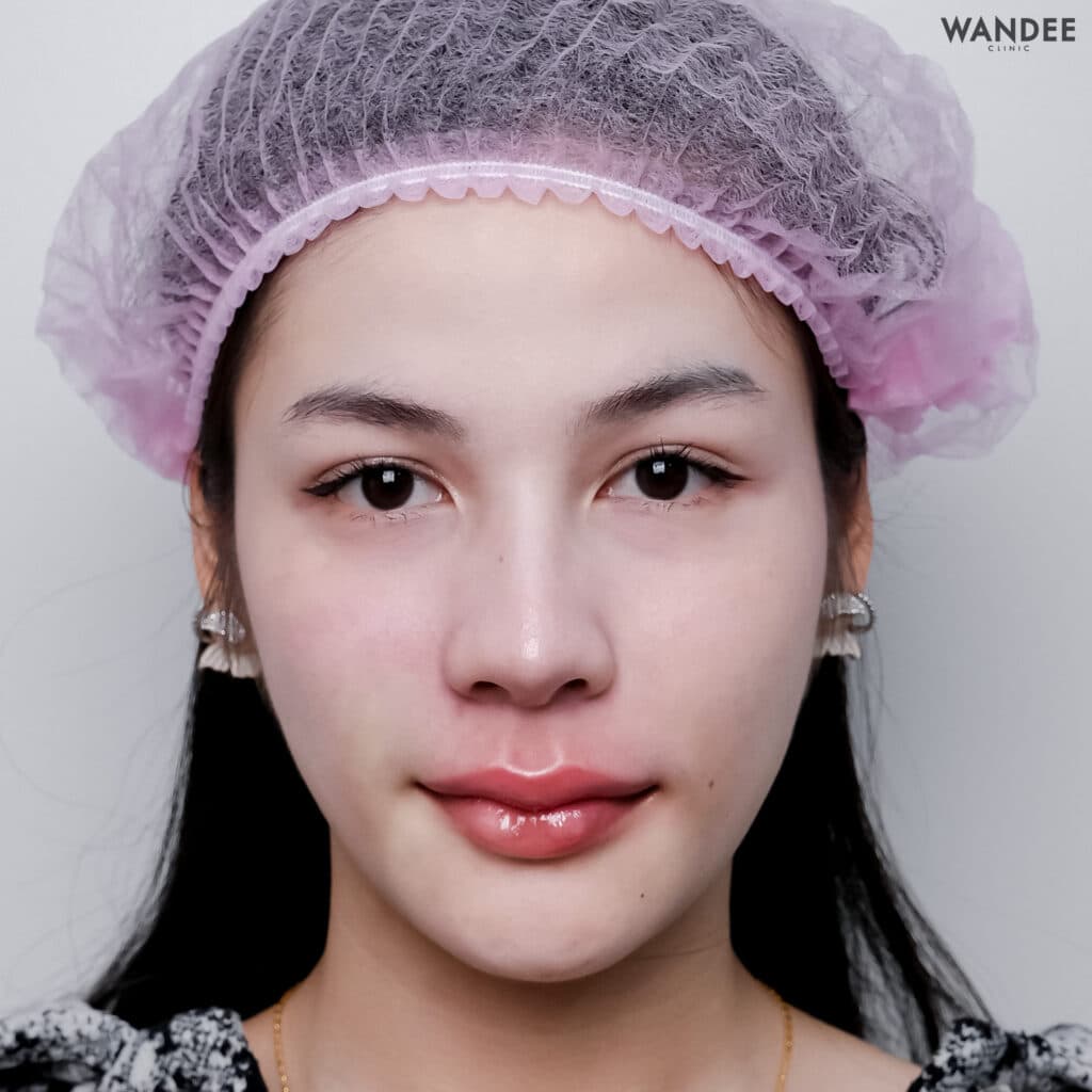 𝐅𝐢𝐥𝐥𝐞𝐫 ใบหน้า