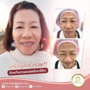 ฉีด botox ที่ไหนดี