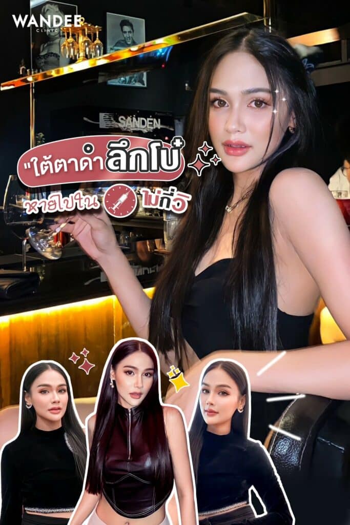 รีวิว Filler ใต้ตา