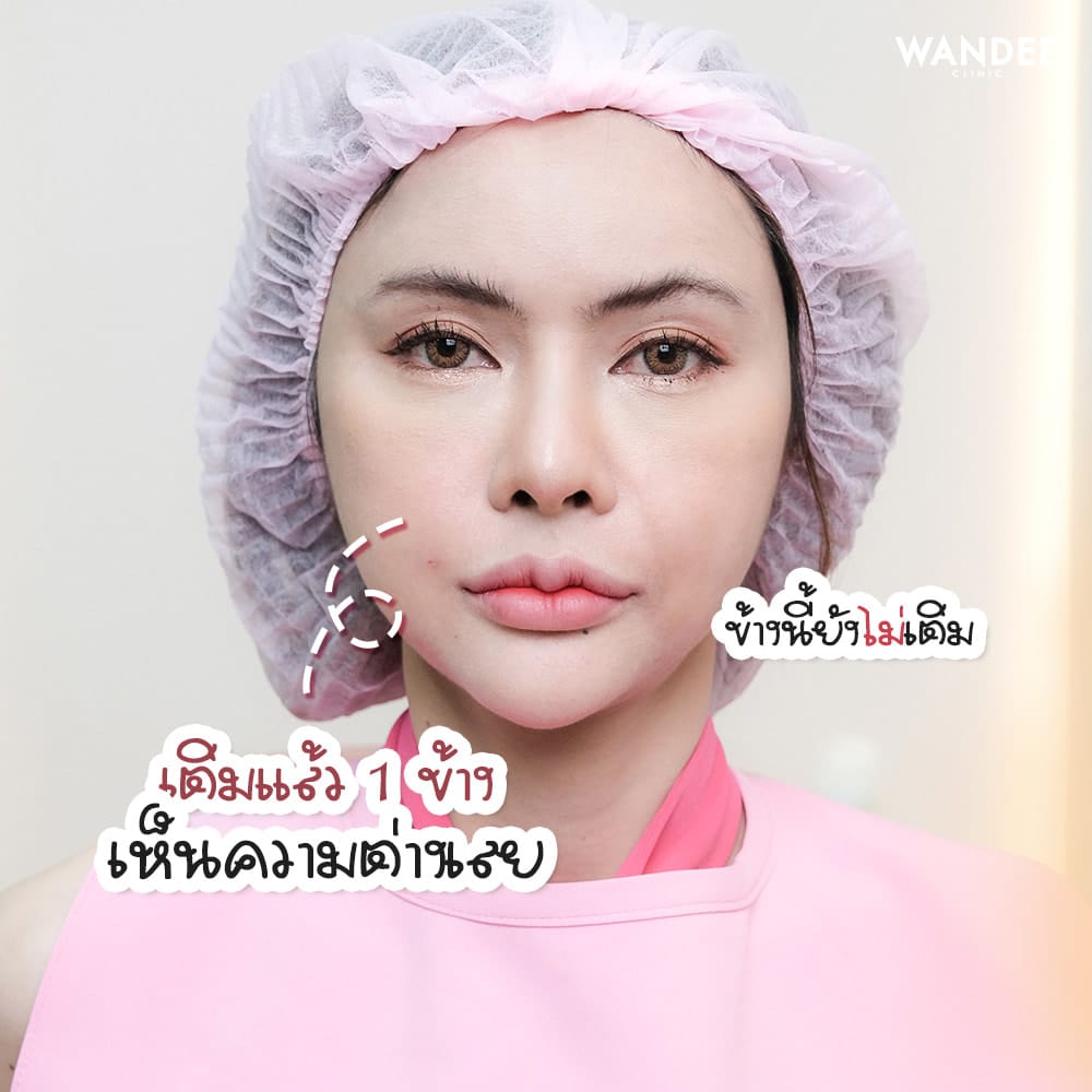 รีวิว Filler