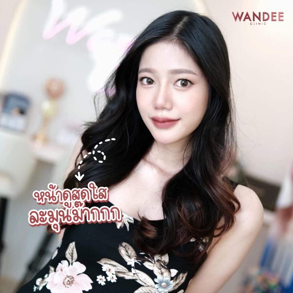 เติม 𝐅𝐢𝐥𝐥𝐞𝐫 ร่องแก้ม