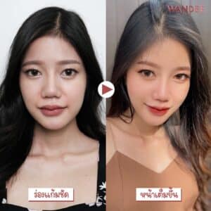 เติม 𝐅𝐢𝐥𝐥𝐞𝐫 ร่องแก้ม