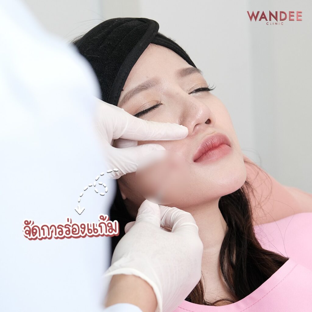 เติม 𝐅𝐢𝐥𝐥𝐞𝐫 ร่องแก้ม