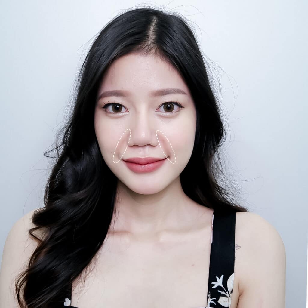 เติม 𝐅𝐢𝐥𝐥𝐞𝐫 ร่องแก้ม