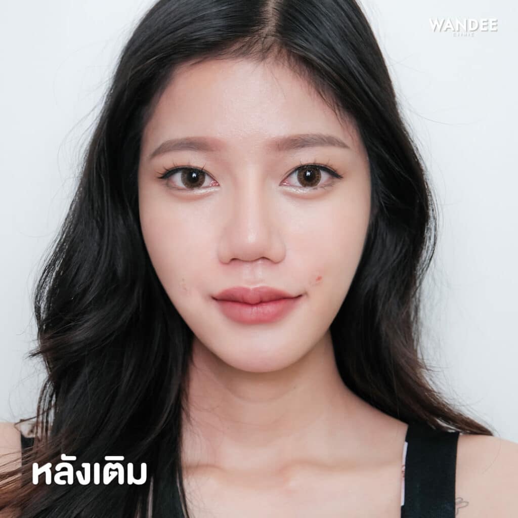 เติม 𝐅𝐢𝐥𝐥𝐞𝐫 ร่องแก้ม