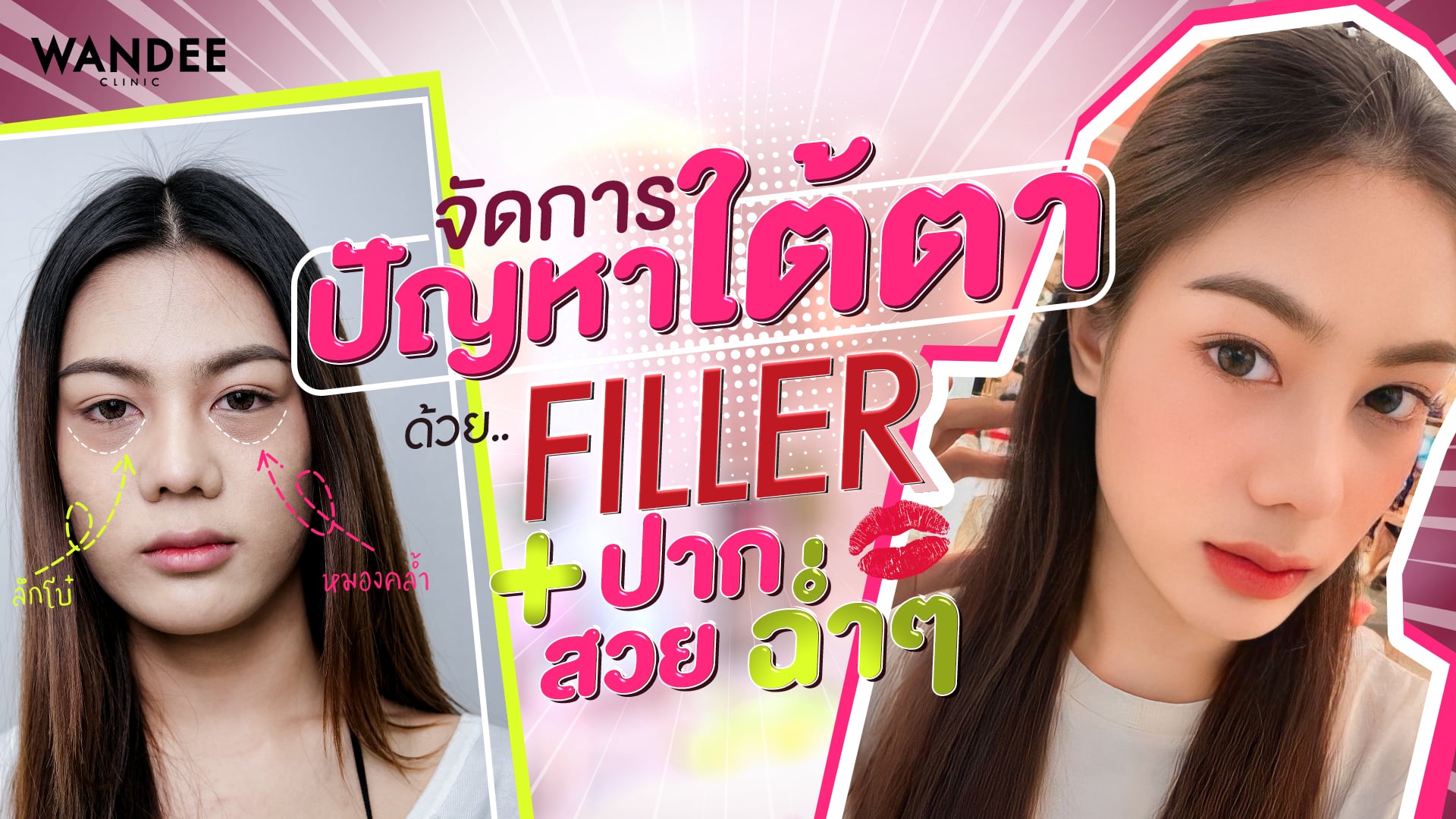 รีวิวฉีดฟิลเลอร์ใต้ตา