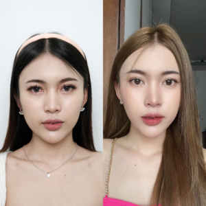 โบท็อกซ์