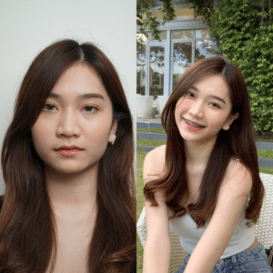 ฉีดโบท็อกซ์