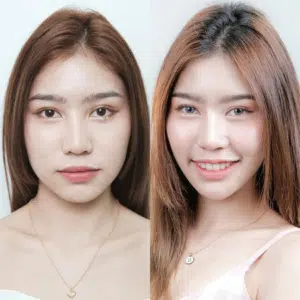 ฉีดโบท็อกซ์