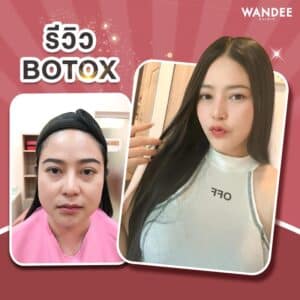 รีวิว 𝐁𝐨𝐭𝐨𝐱 ลดกราม