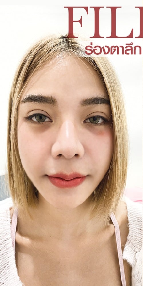 𝐅𝐢𝐥𝐥𝐞𝐫 เติมเต็มใต้ตา