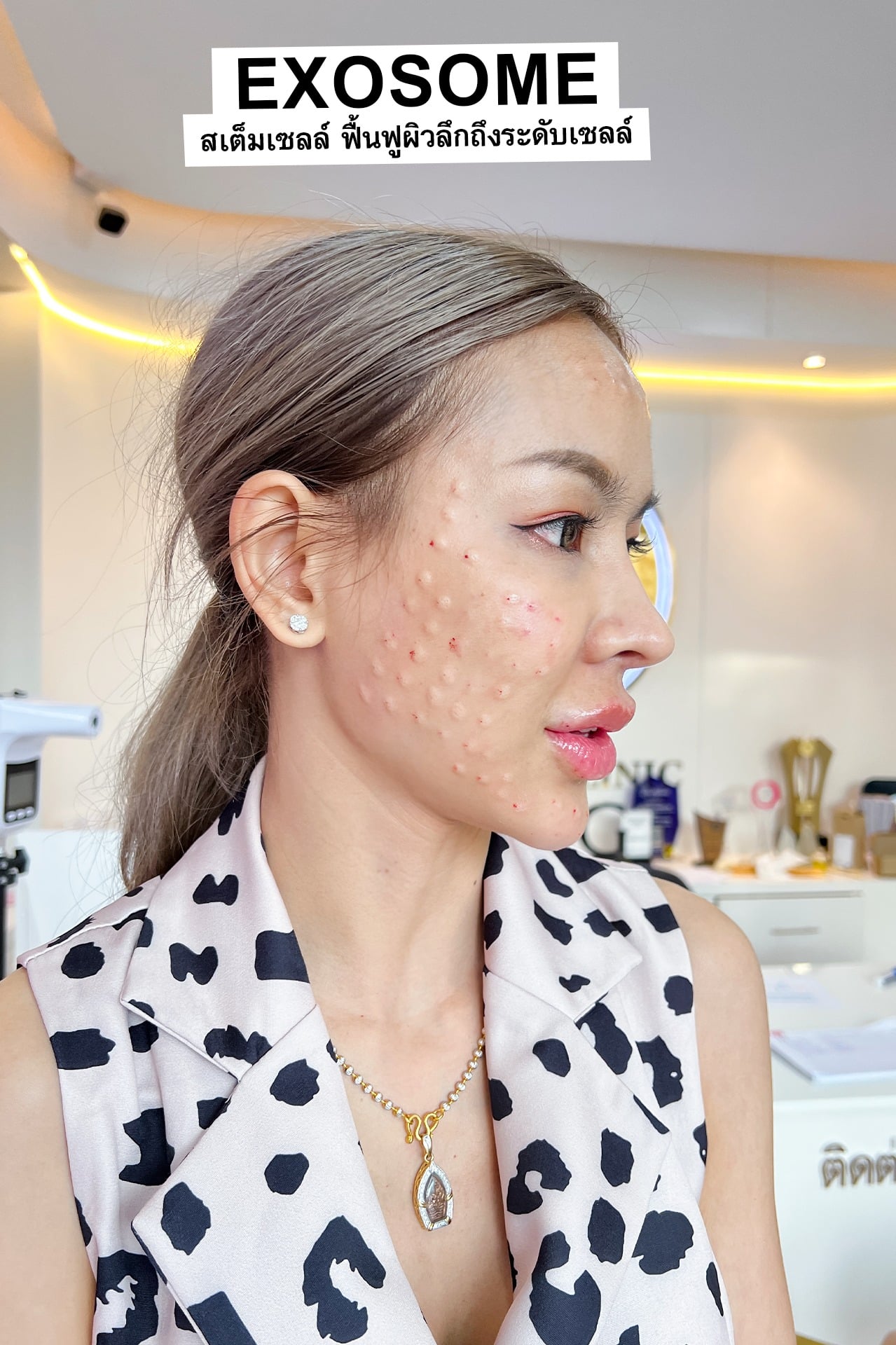 ASCE PLUS EXOSOME ดีอย่างไร?