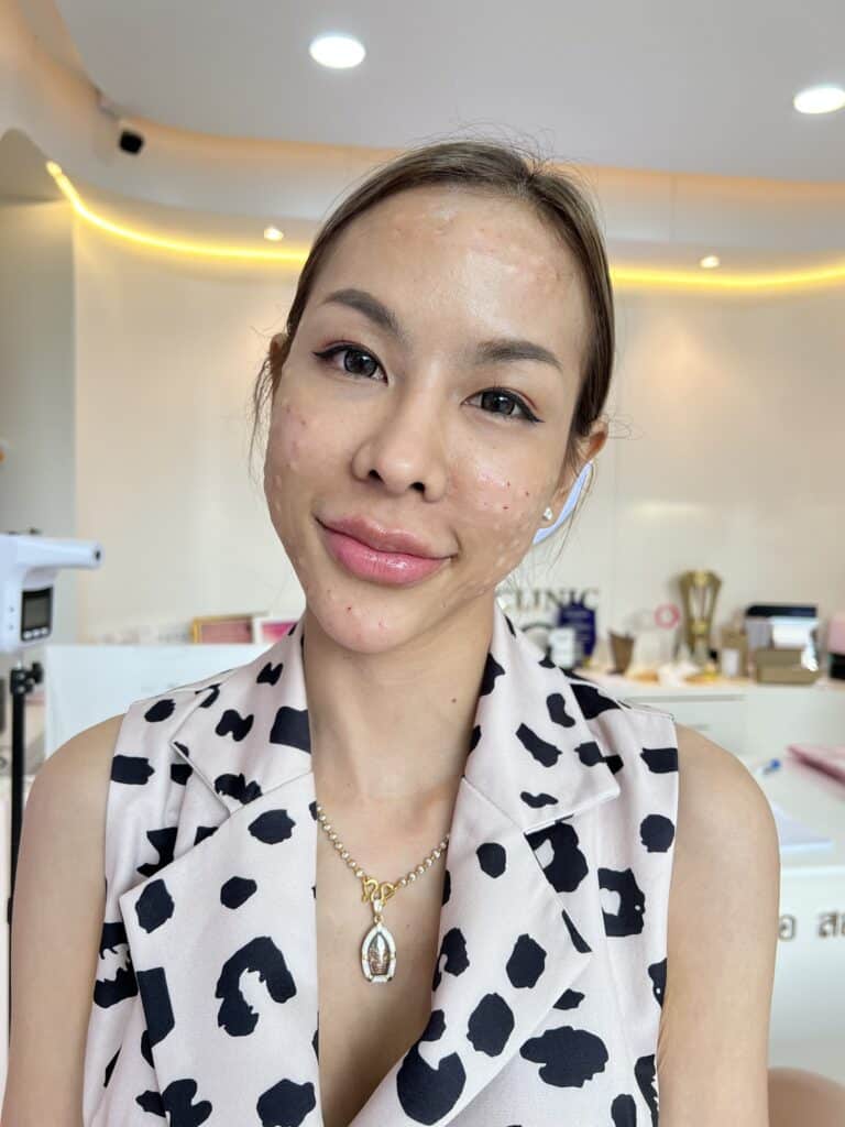 ฉีด ASCE PLUS EXOSOME