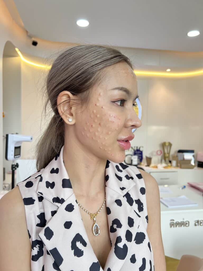 ฉีด ASCE PLUS EXOSOME