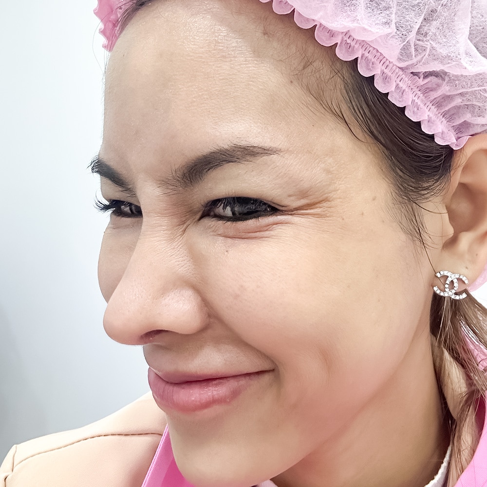 𝗕𝗢𝗧𝗢𝗫 ริ้วรอย แบบจุก ๆ