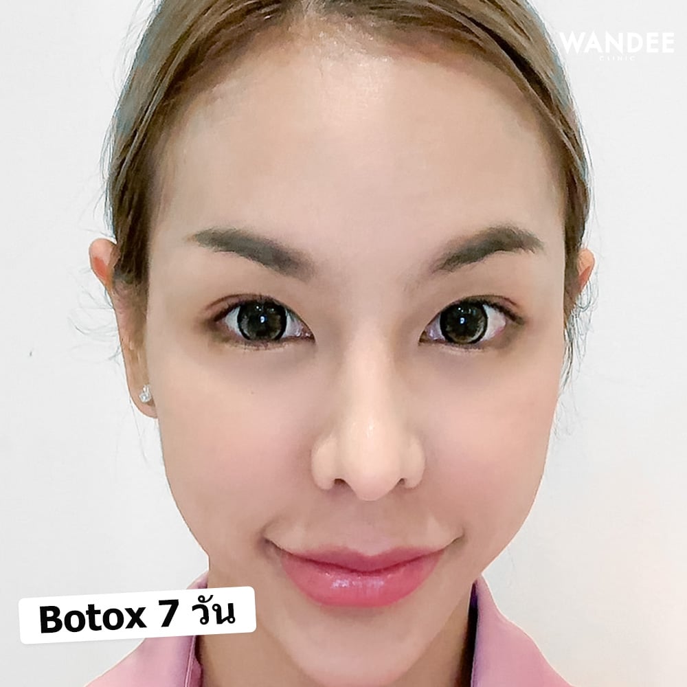 𝗕𝗢𝗧𝗢𝗫 ริ้วรอย แบบจุก ๆ