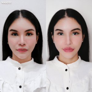 ฟิลเลอร์ปาก