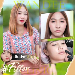 เติม 𝐅𝐢𝐥𝐥𝐞𝐫 ปากที่วันดีคลินิก