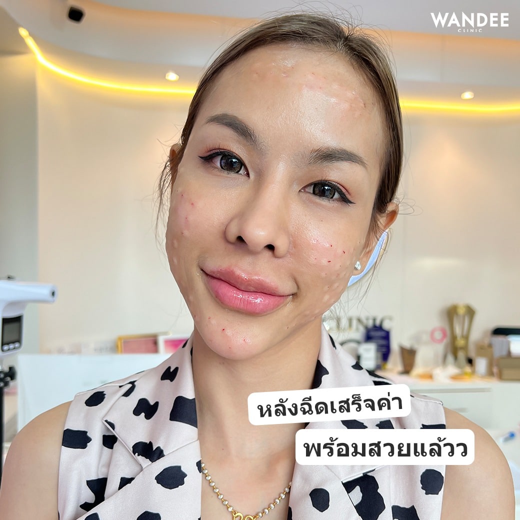 ASCE PLUS EXOSOME ดีอย่างไร?