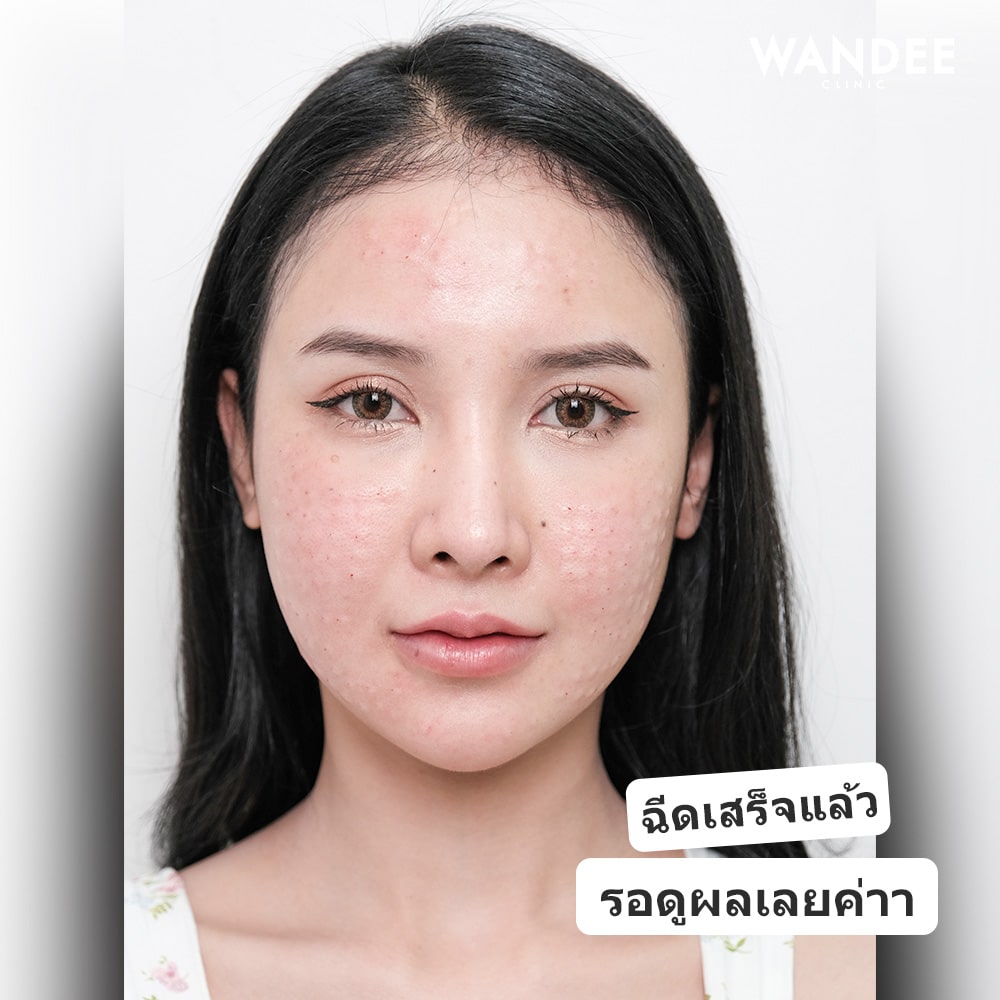 หลังฉีด 𝐑𝐞𝐣𝐮𝐫𝐚𝐧