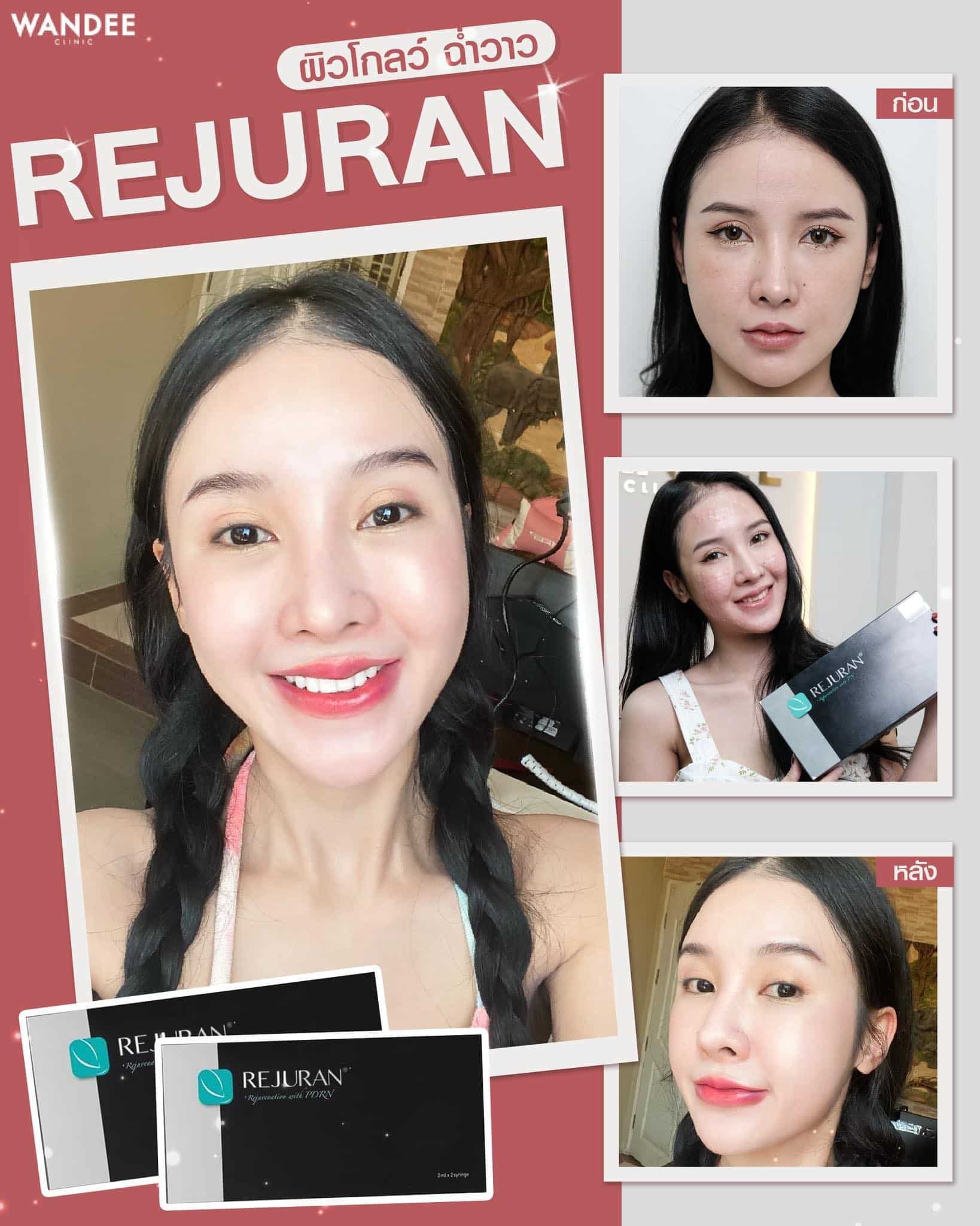 หลังฉีด 𝐑𝐞𝐣𝐮𝐫𝐚𝐧