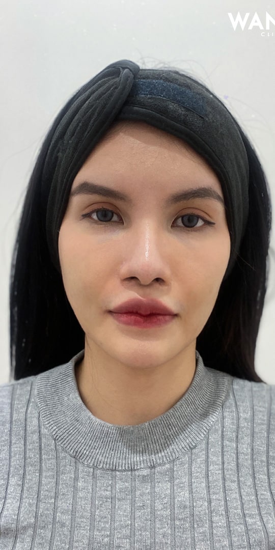 𝗙𝗜𝗟𝗟𝗘𝗥 ปากสายฝอ