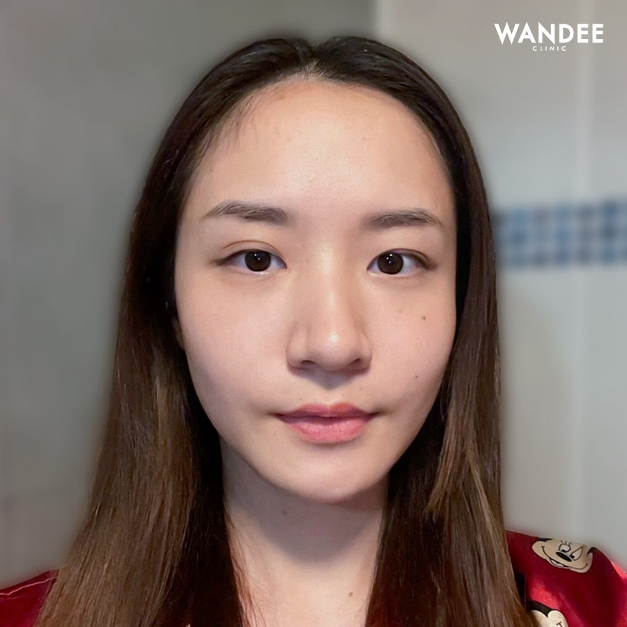 𝗙𝗜𝗟𝗟𝗘𝗥 ใต้ตา