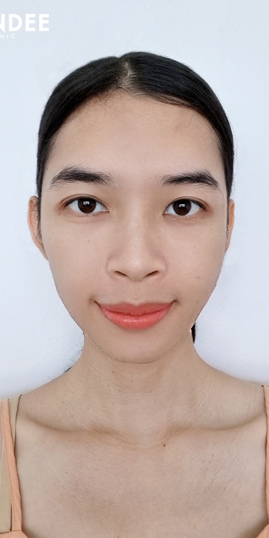 𝗙𝗜𝗟𝗟𝗘𝗥 ขมับ