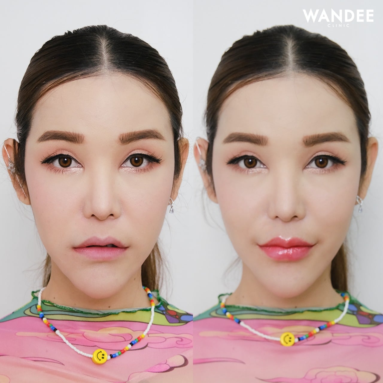 เติม 𝗙𝗜𝗟𝗟𝗘𝗥 ปากครั้งแรก