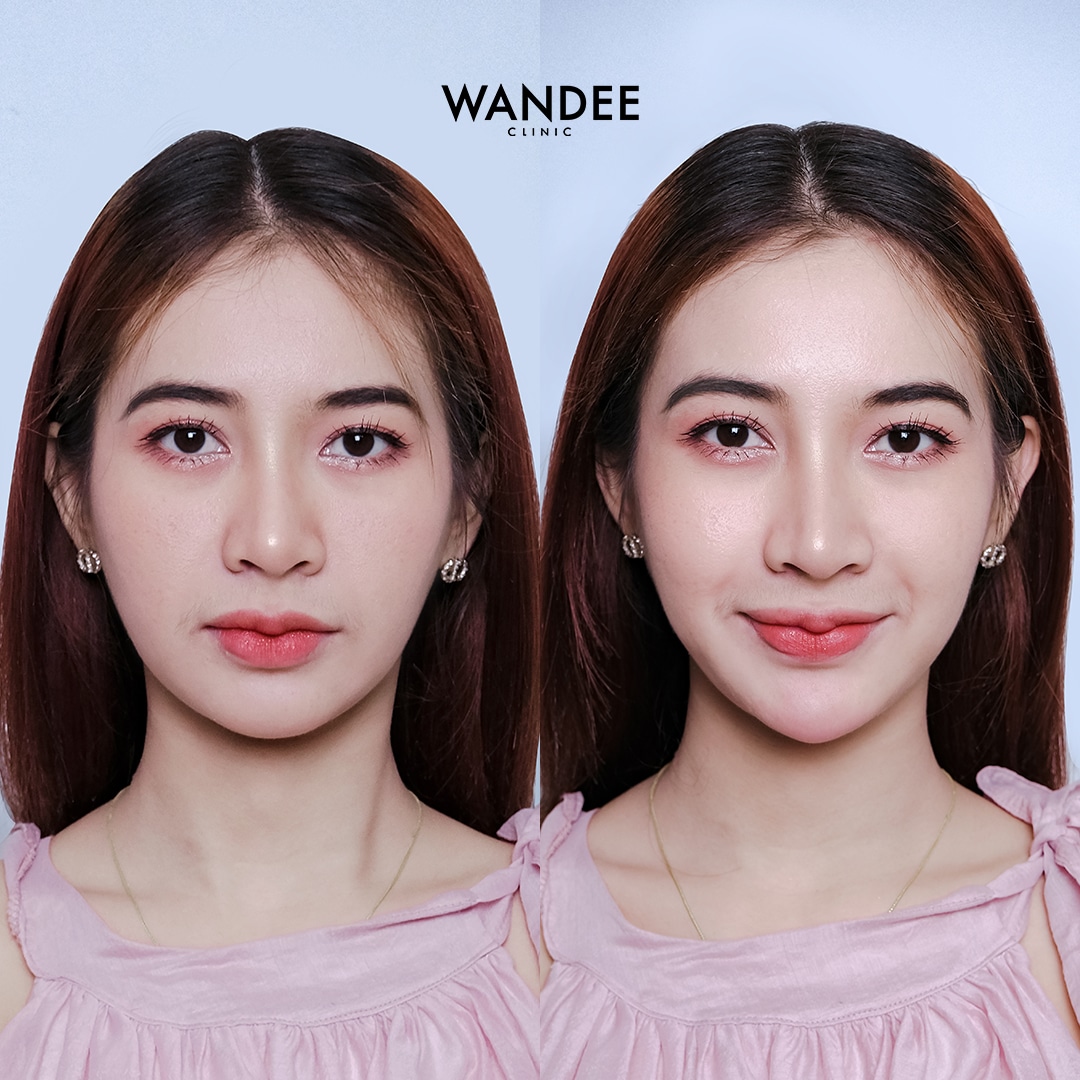 ฟิลเลอร์คาง