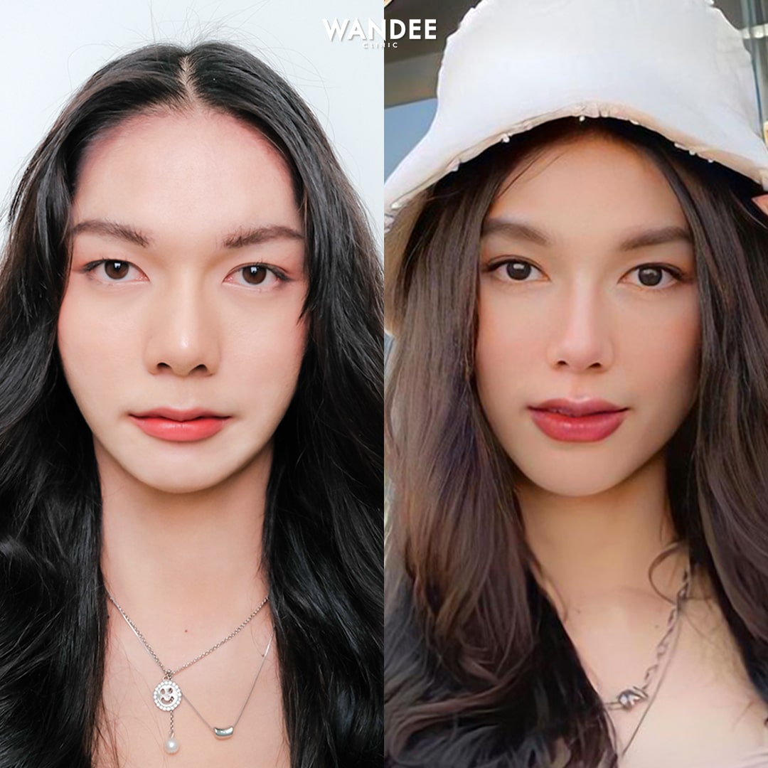 ฟิลเลอร์ปาก